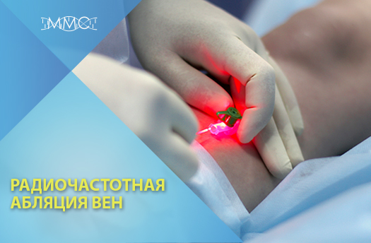 Радиочастотная абляция вен